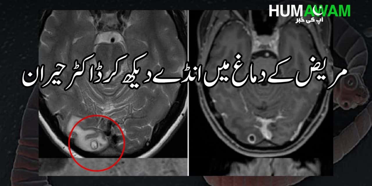 مریض کے دماغ میں جانور کے انڈے دیکھ کر ڈاکٹر حیران‎